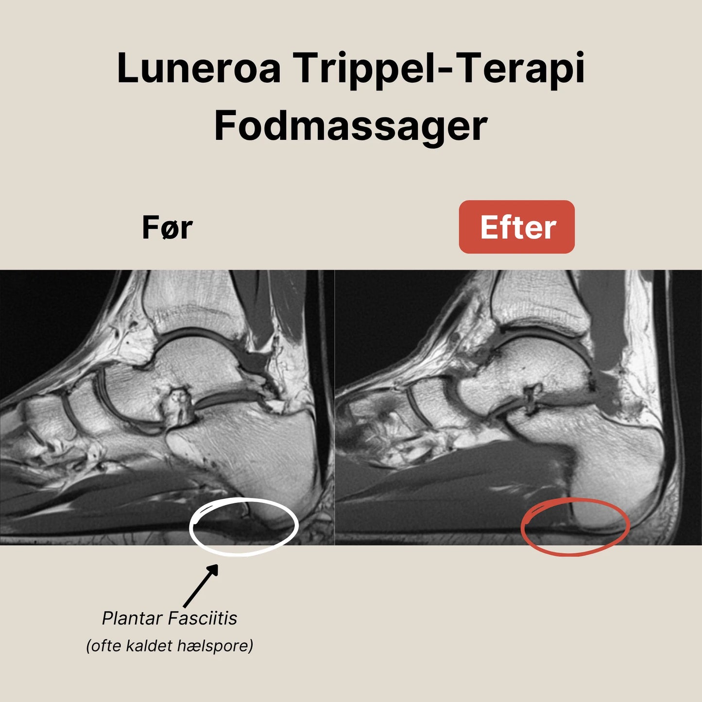 Luneroa Trippel-Terapi Fodmassager