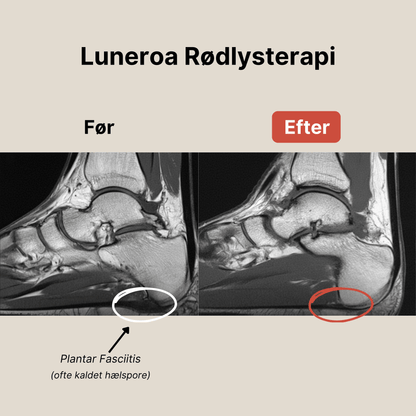 Luneroa Rödljusterapi
